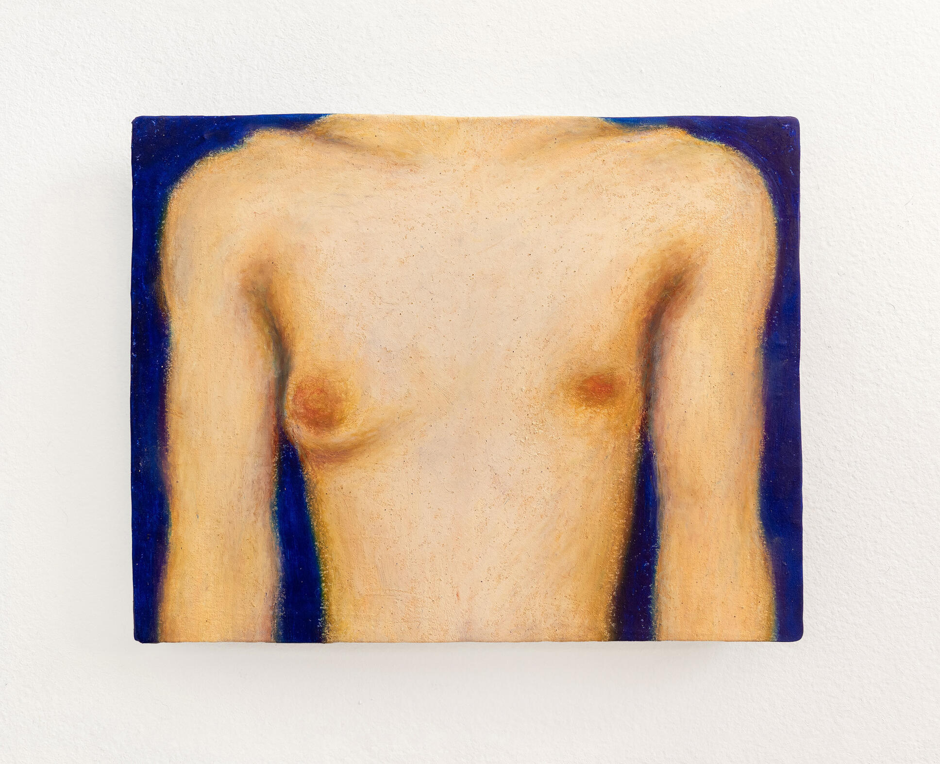 Unilateral gynecomastia